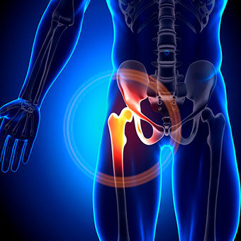 ¿Qué necesito para la recuperación de una fractura de cadera?